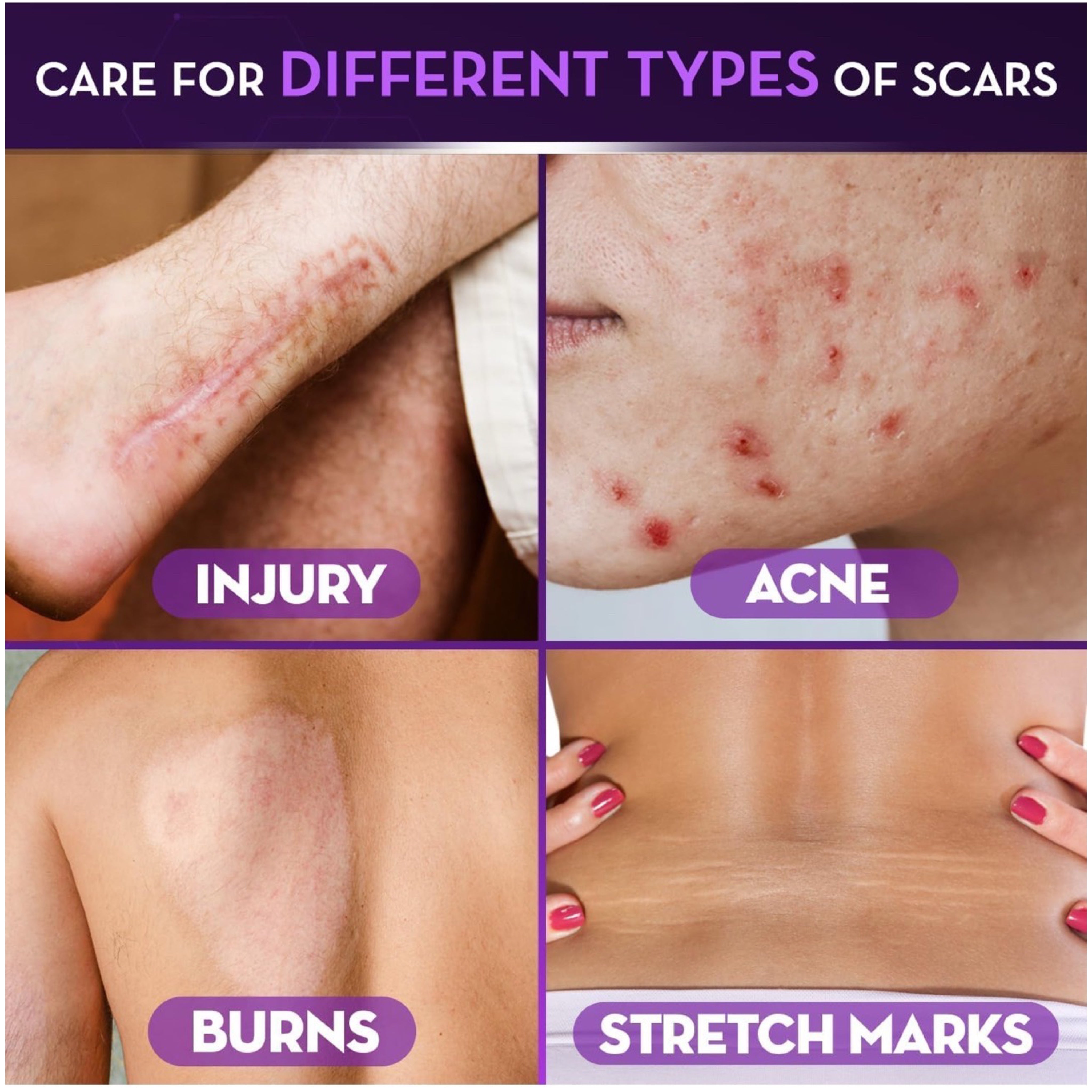 Cicatricure Face & Body Scar Gel